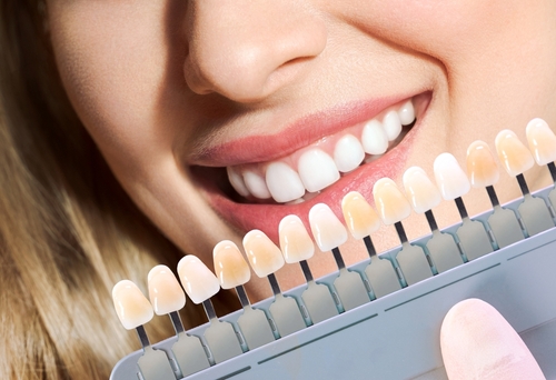 Teeth Whitening Tips for Maintaining Your Smile After Treatment