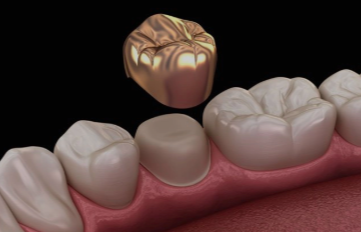 The Evolution of Dental Crowns: From Materials to Techniques