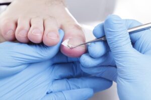 Ingrown Toenails: How They Develop and How to Treat Them